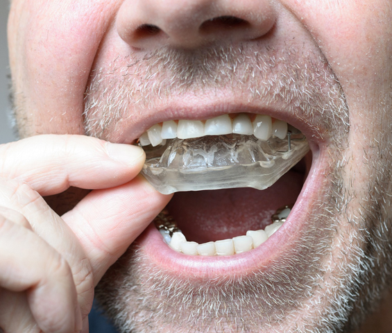 Night Guards in Middletown-Advanced Family & Cosmetic Dentistry Middletown
