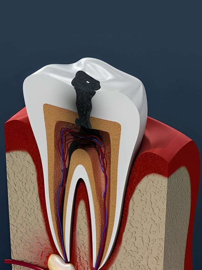 Root Canal Treatment in Middletown-Advanced Family & Cosmetic Dentistry Middletown