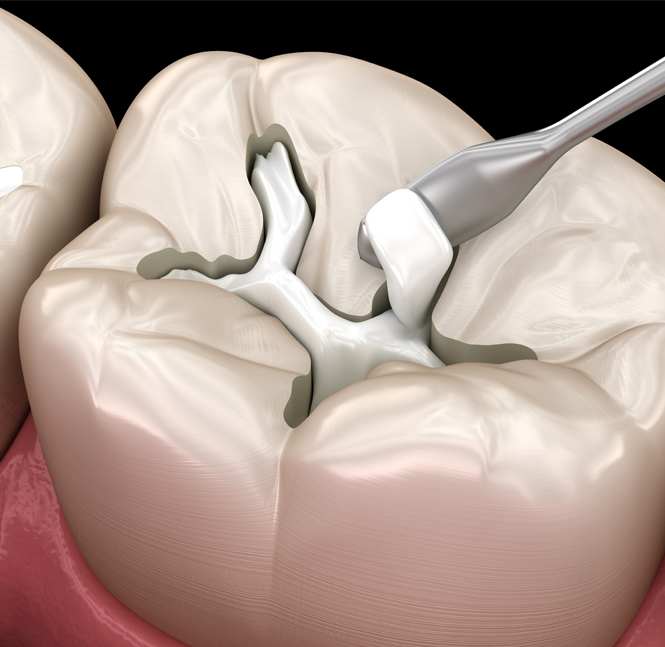 Tooth Colored Fillings in Middletown-Advanced Family & Cosmetic Dentistry Middletown