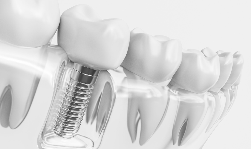 dental implants in middletown