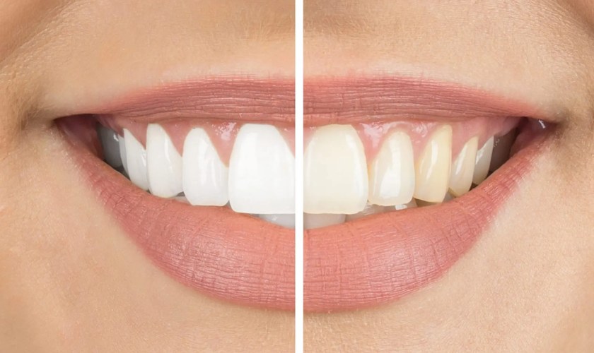 teeth whitening in middletown