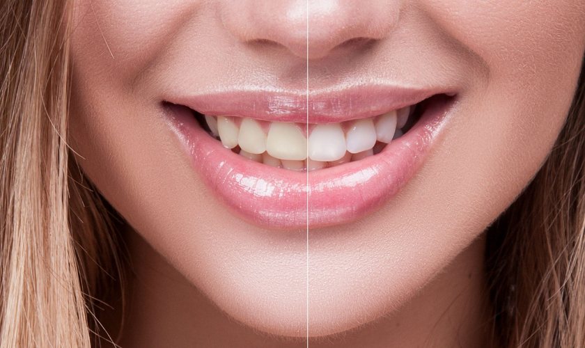 teeth whitening middletown